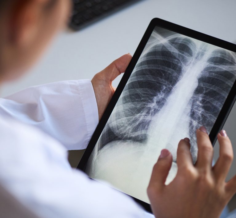 CE MDR Class IIb certification - Nexus AI CXR as a Software as a Medical Device for chest X-ray TB screening