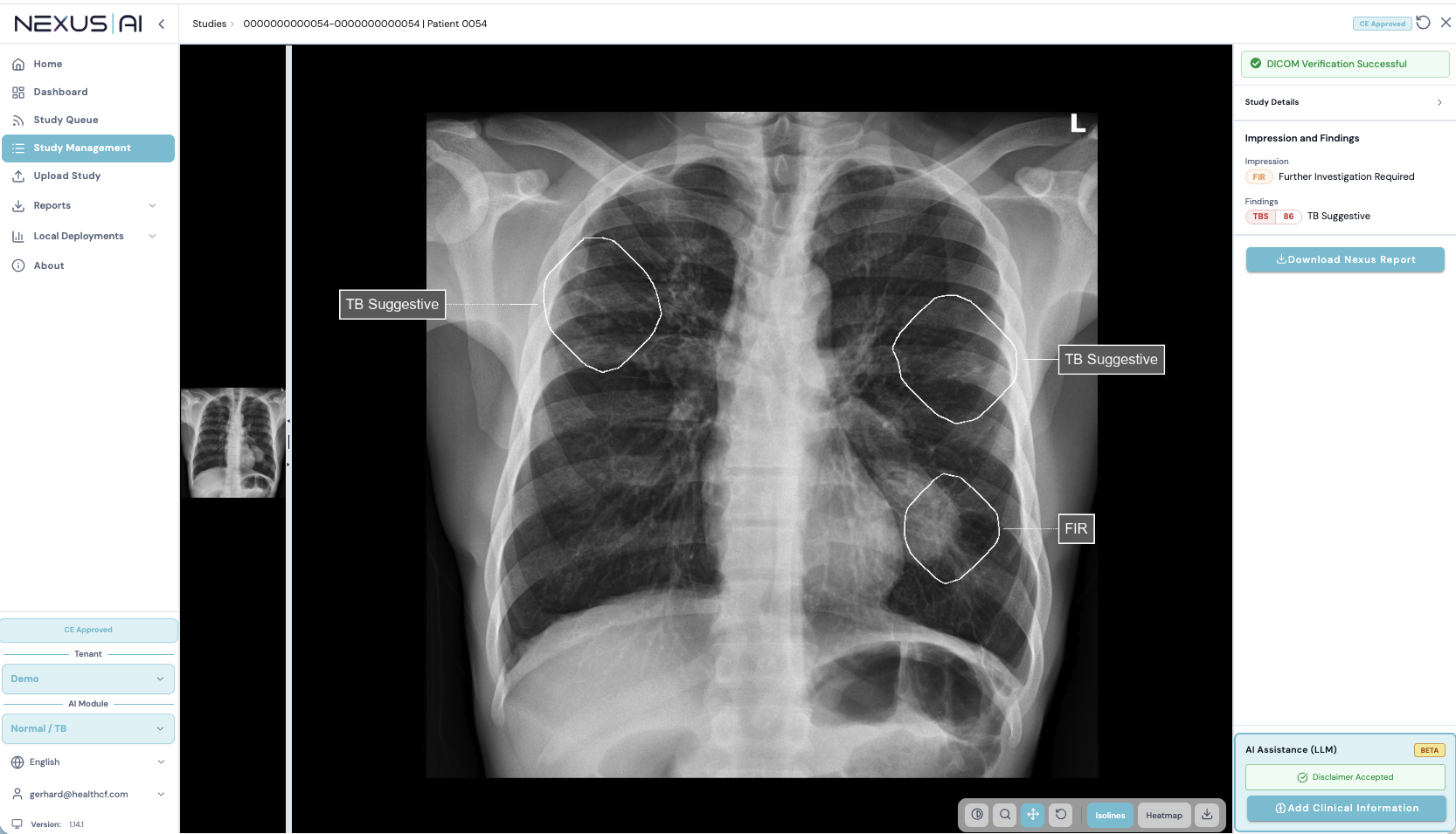 Nexus AI CXR study view with FIR and TB Suggestive AI annotations on chest X-ray