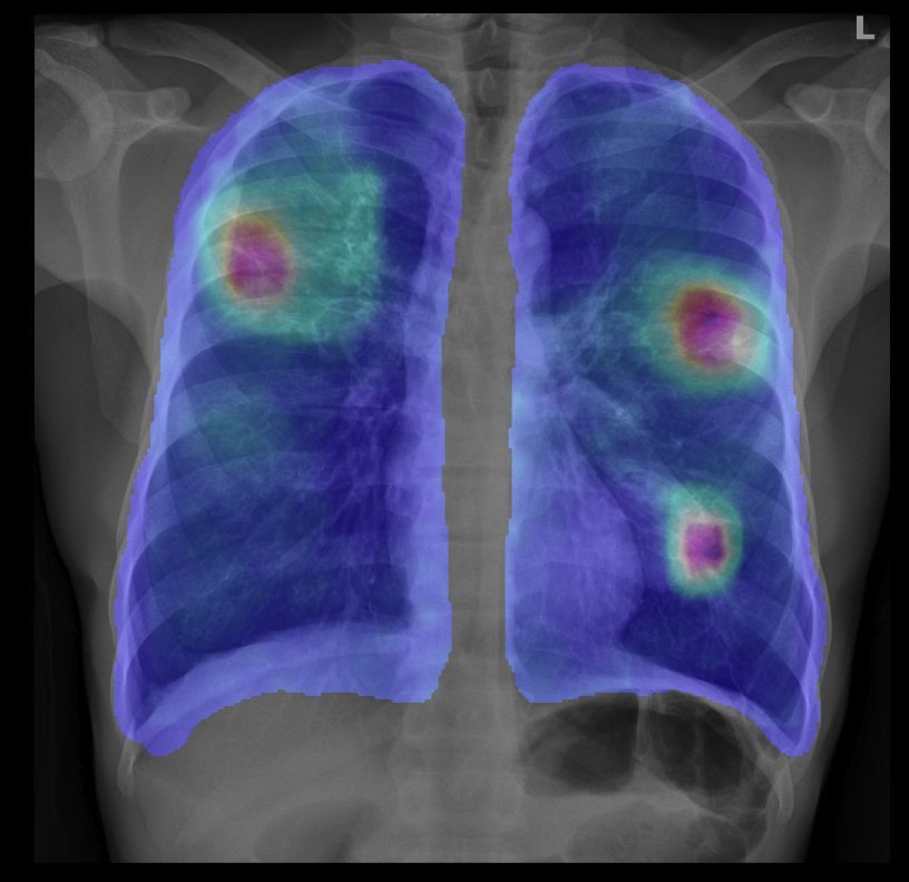 Chest X-ray with Nexus AI heatmap visualisation for TB and lung pathology detection
